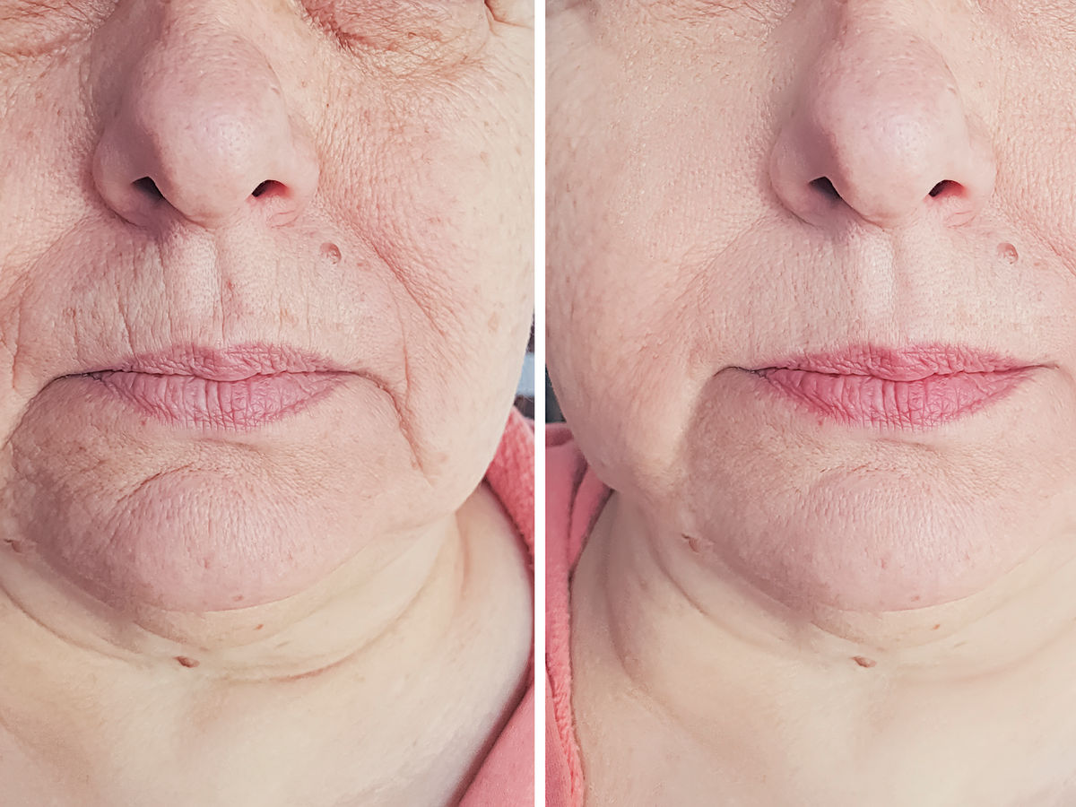Skin rejuvenation example image